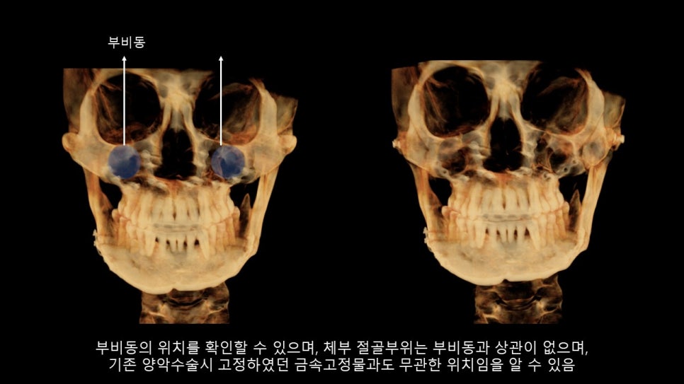광대뼈축소성형술 증례 리뷰 -1 관련 이미지 19
