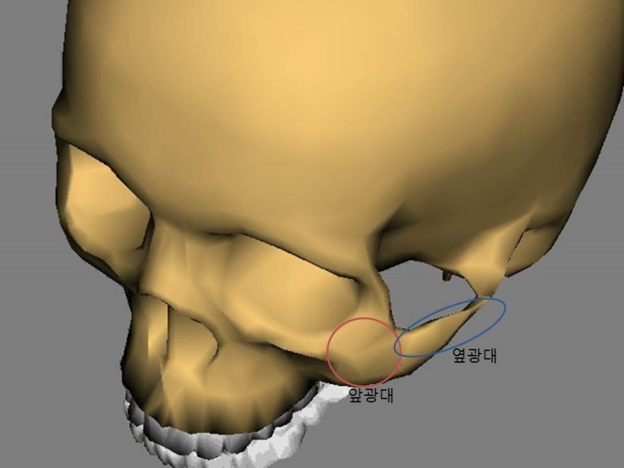 Meticulous Zygomatic Reduction Surgery image 1