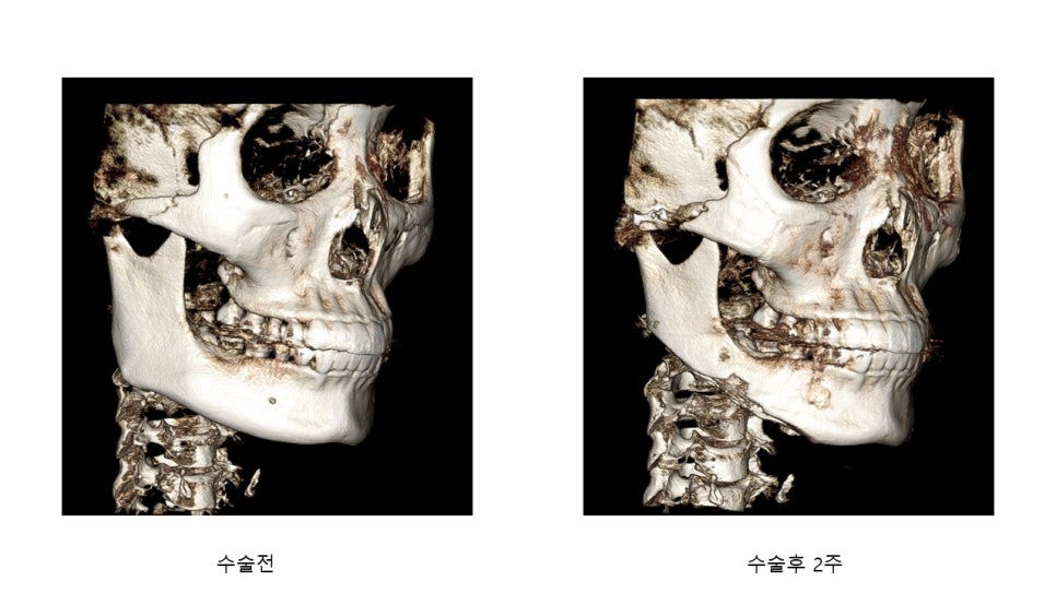 사각턱 수술후 시기에 따른 아랫턱뼈의 형태변화 관련 이미지 24