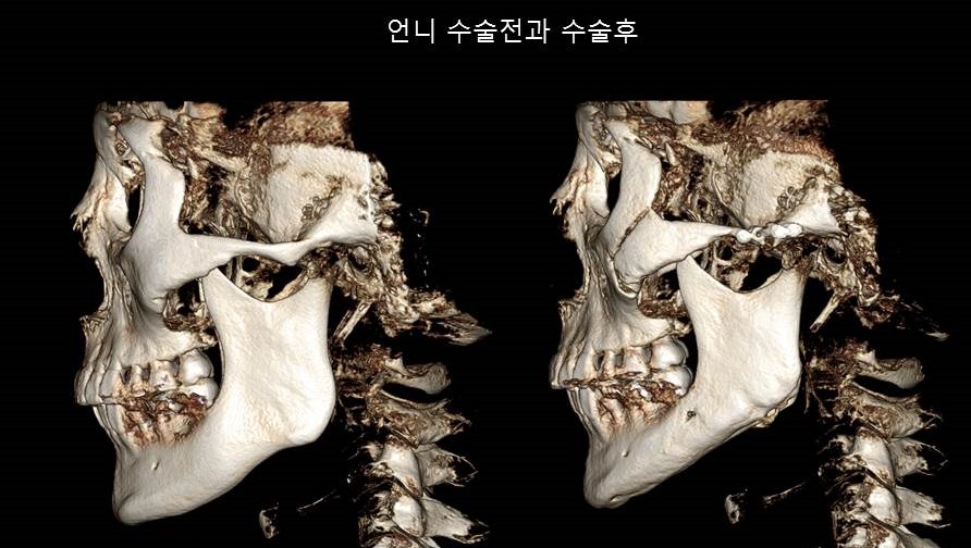 Understanding Square Jaw Surgery - Comparison of Postoperative Results Between Biological Sisters Who Underwent Surgery Using Different Methods image 5