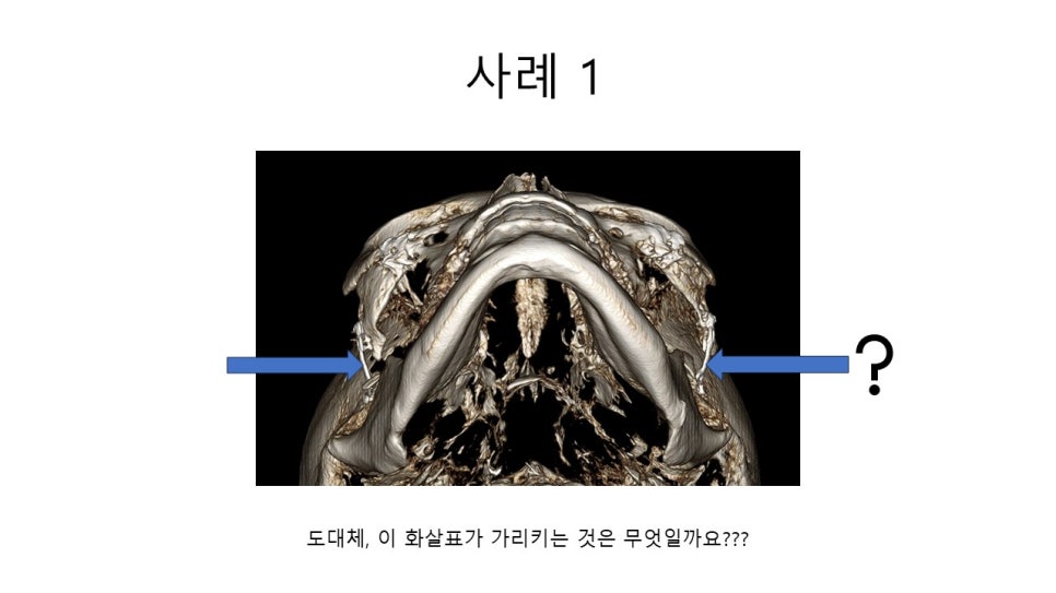 A Zygomatic Surgery Outcome That Makes Anger Surge image 5