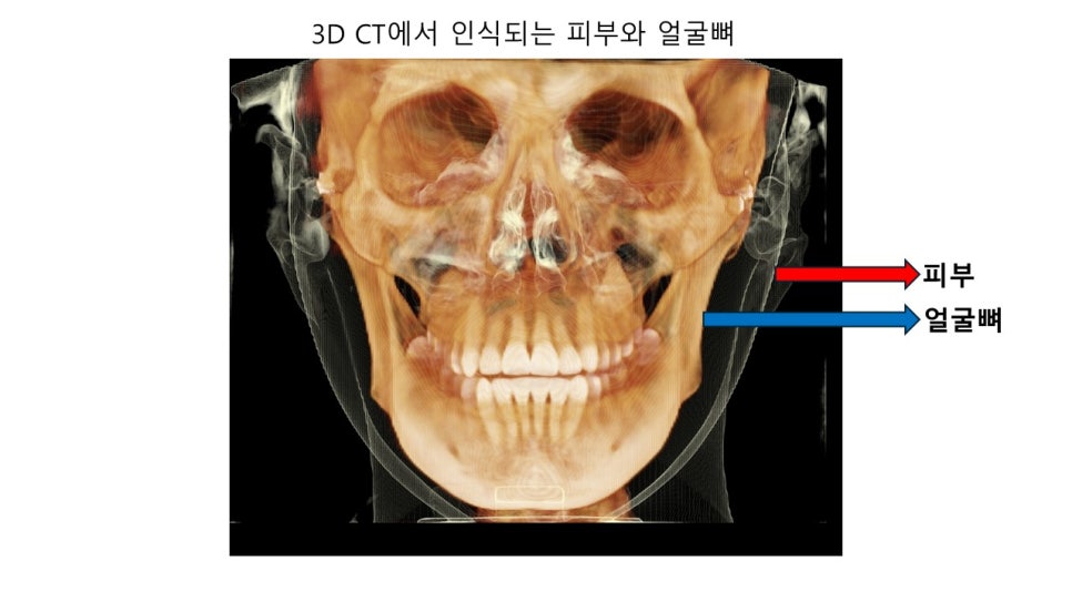 얼굴 윤곽에 있어서 연부조직의 중요성 - 윤곽주사, 레인보우 주사 관련 이미지 1