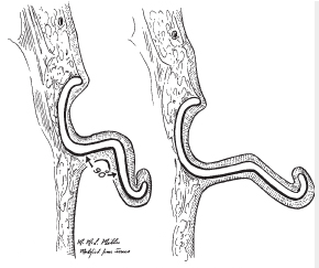 Protruding Ear Surgery image 1