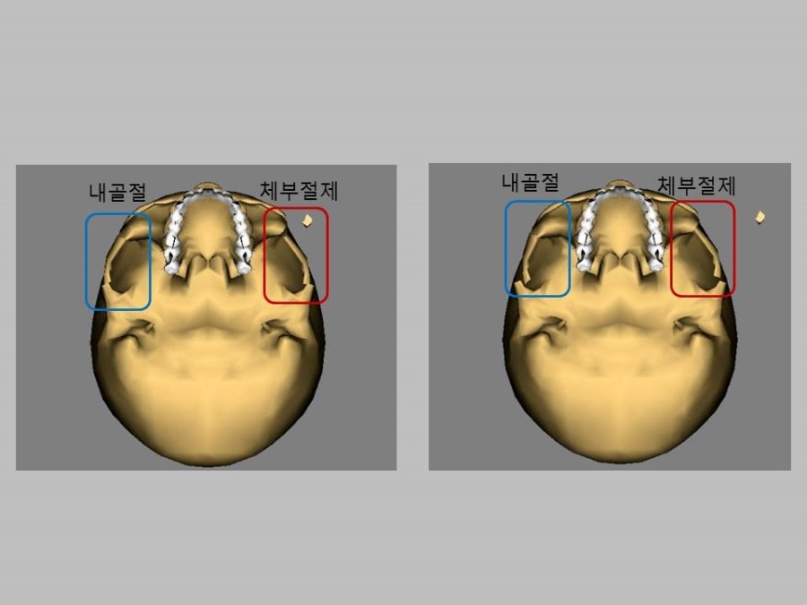 Meticulous Zygomatic Reduction Surgery image 3