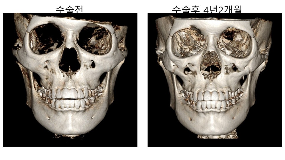 얼굴 윤곽에 있어서 연부조직의 중요성 - 윤곽주사, 레인보우 주사 관련 이미지 5