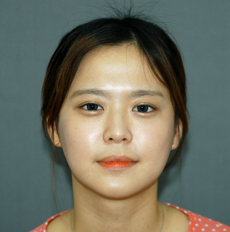 Progress After Facial Contouring Surgery 1 - Zygoma Reduction Surgery and Square Jaw Surgery image 5