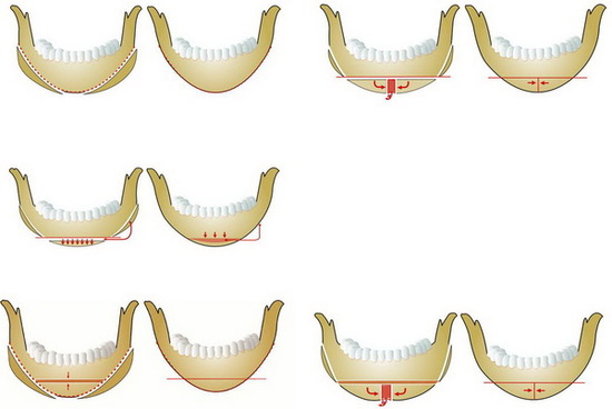 V-Line Facial Contouring Surgery image 1
