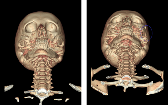 Revision Surgery for Cheekbone Surgery...Closing the Gap and Fixing the Side Cheekbone. image 2