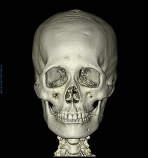 안면골의 삼차원 단층촬영(3D-CT, 3DCT) 란? 관련 이미지 1