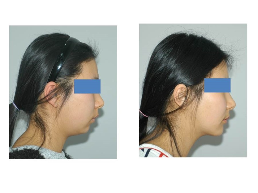 Deep Buccal Fat Removal, Double Chin Liposuction, and Progress After Genioplasty image 4