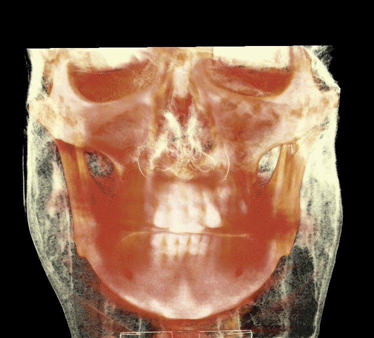 A General Understanding of Facial Contouring Surgery image 5