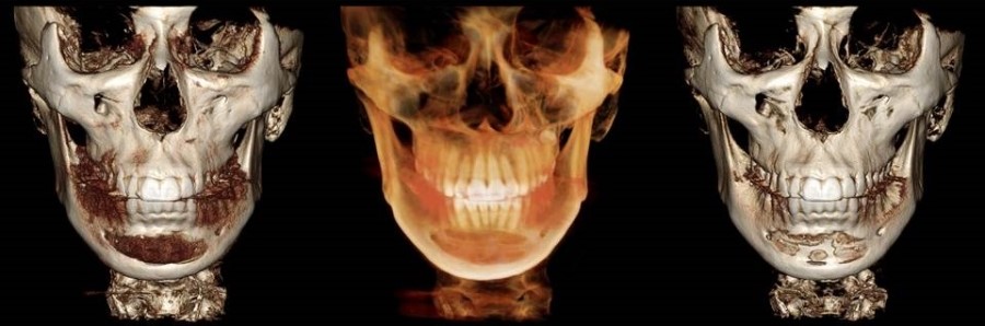 Various Methods of Chin Surgery for Correcting a Recessed Chin and Their Pros and Cons image 6