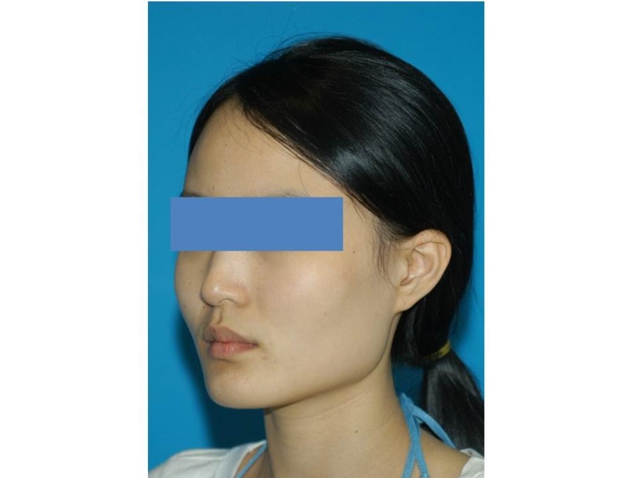 사각턱 수술과 V-라인 사각턱 수술 관련 이미지 1