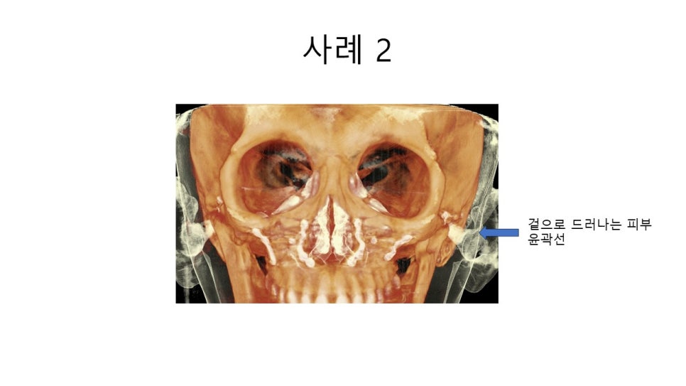 A Zygomatic Surgery Outcome That Makes Anger Surge image 16