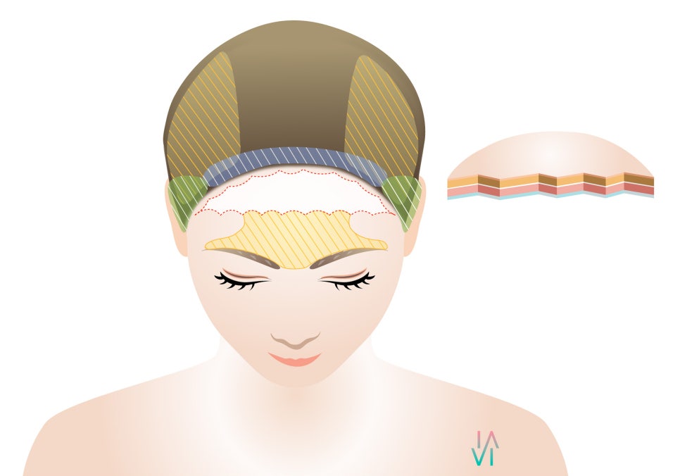 A Proposal to Improve a Broad Forehead - Binary Surgery image 4