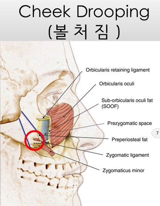 광대뼈축소성형술 - 볼처짐의 원인에 관한 이해 관련 이미지 3