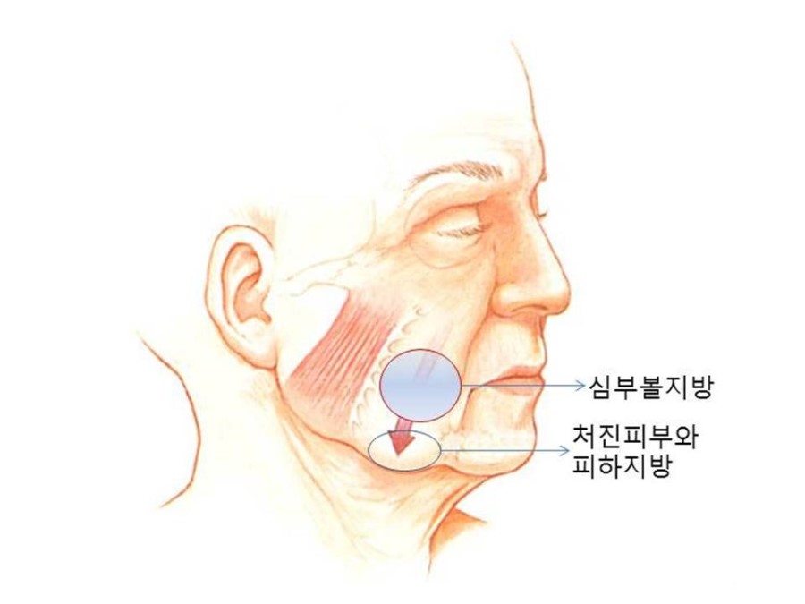 심부볼지방제거-부위,수술방법,치료과정및 경과 관련 이미지 5