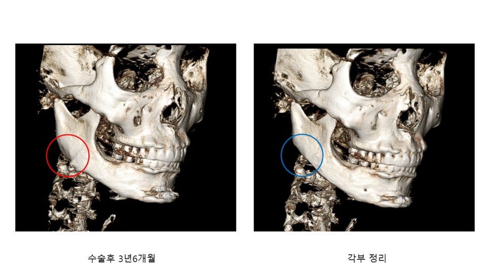 사각턱 수술후 시기에 따른 아랫턱뼈의 형태변화 관련 이미지 13
