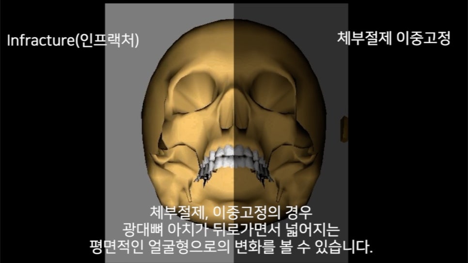 Why Do So Many People Consider Revision Surgery After Zygomatic Reduction Surgery? image 3
