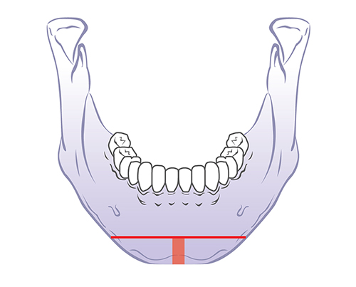 V-Line Square Jaw Surgery - The Appropriate Surgical Method According to the Shape of the Chin image 2