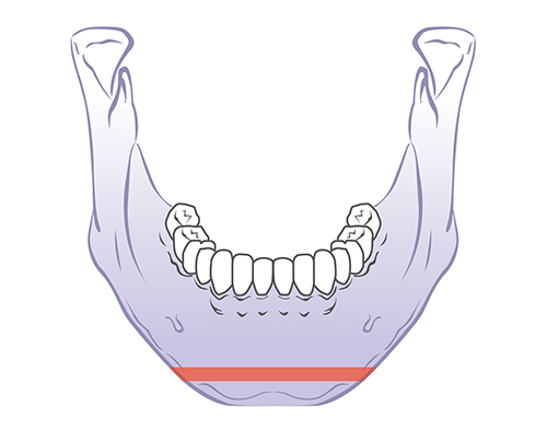 V-Line Square Jaw Surgery - The Appropriate Surgical Method According to the Shape of the Chin image 6