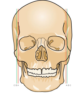Understanding the Structure of the Cheekbone and Cheekbone Reduction Surgery image 9