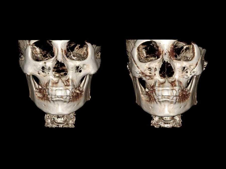 Zygoma Reduction Surgery Through Complete Osteotomy of the Body and Arch image 12