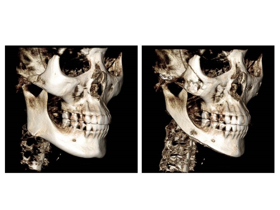 Proper Understanding of Cortical Bone Resection or Cortical Bone Reduction in Square Jaw Surgery image 8