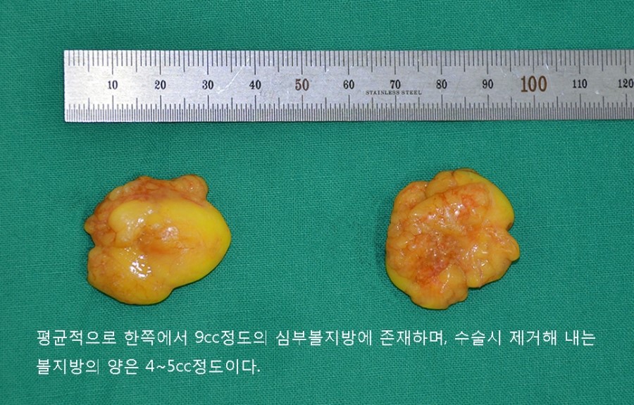 양악수술과 심부볼지방제거 관련 이미지 5