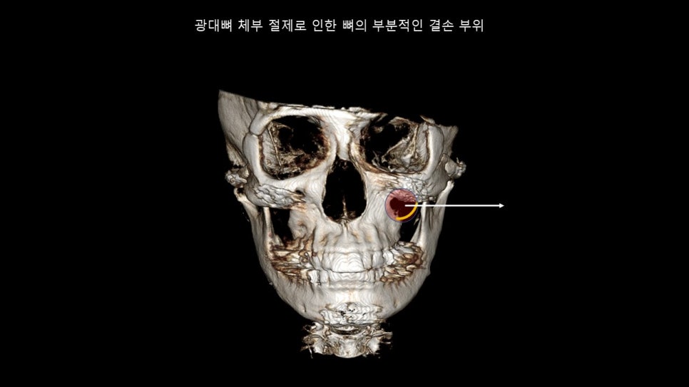 광대뼈축소성형술 증례 리뷰 -1 관련 이미지 5