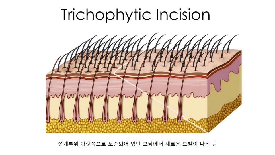 넓은 이마와 처진 눈매 고민 끝! "이마거상, 이마축소, 그리고 바이나리" 관련 이미지 12