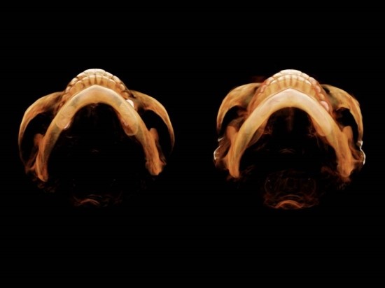 Lateral Cheekbone Reduction Surgery image 1