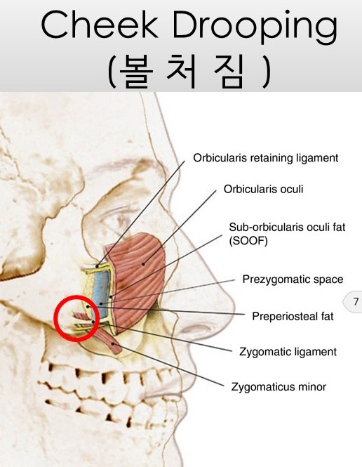 광대뼈축소성형술 - 볼처짐의 원인에 관한 이해 관련 이미지 2