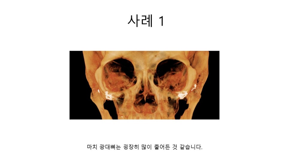 A Zygomatic Surgery Outcome That Makes Anger Surge image 9