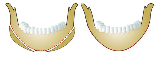 V-Line Facial Contouring Surgery - 1. When the Chin Length Is Appropriate image 1