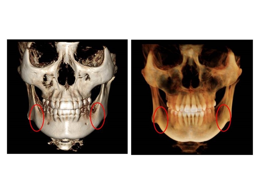 Proper Understanding of Cortical Bone Resection or Cortical Bone Reduction in Square Jaw Surgery image 4