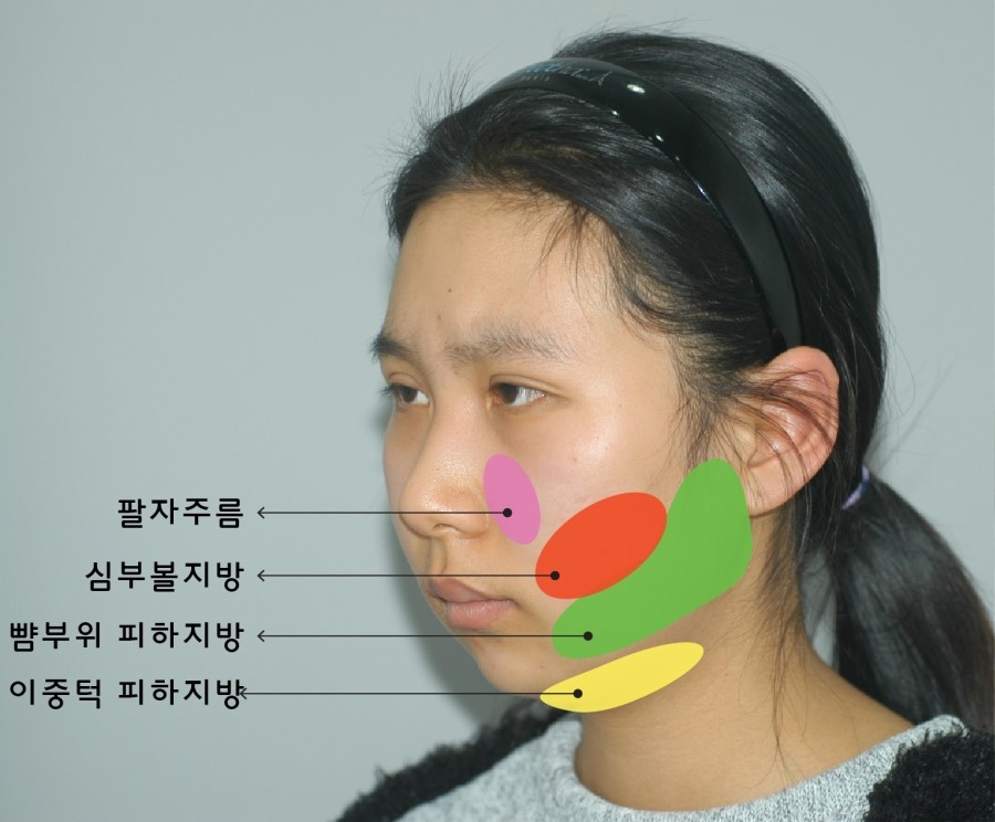 심부볼지방의 위치와 심부볼지방제거 수술시 개선되는 부위 관련 이미지 2