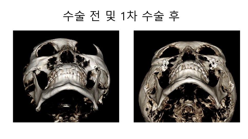 광대뼈 축소성형술 - 수술방법에 따른 모습변화의 차이 관련 이미지 9