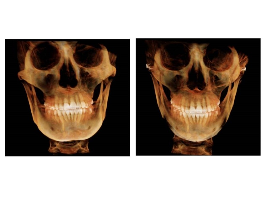 V-Line Square Jaw Surgery - The Appropriate Surgical Method According to the Shape of the Chin image 12