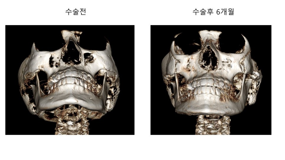 안면윤곽 수술전과 후의 증례 고찰 관련 이미지 9