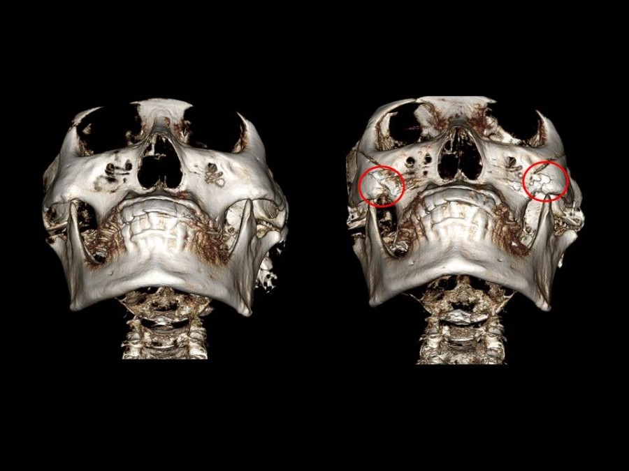 Zygoma Reduction Surgery Through Complete Osteotomy of the Body and Arch image 16