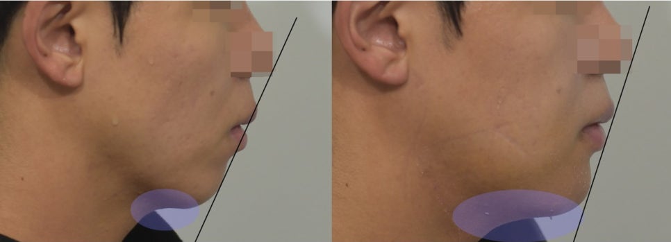 입체적인 옆라인의 완성, 무턱과 이중턱을 동시에 해결하는 방법 관련 이미지 29