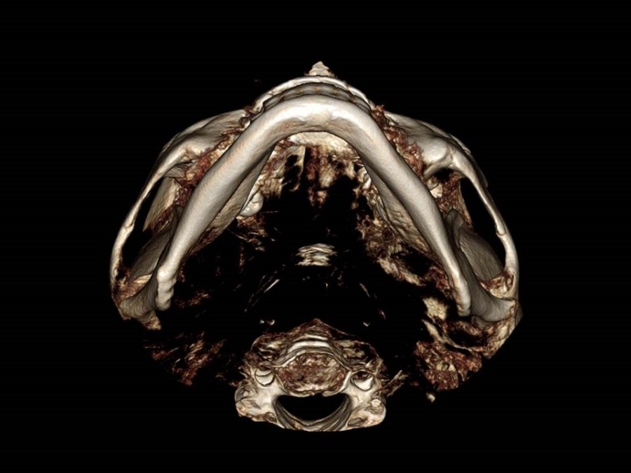 Understanding the Structure of the Cheekbone and Cheekbone Reduction Surgery image 2