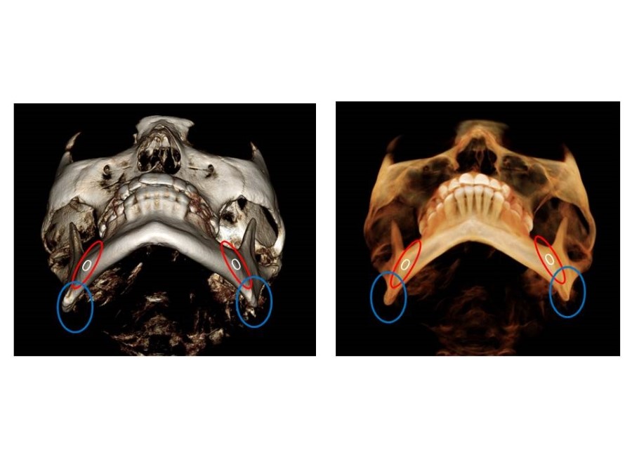 Proper Understanding of Cortical Bone Resection or Cortical Bone Reduction in Square Jaw Surgery image 2