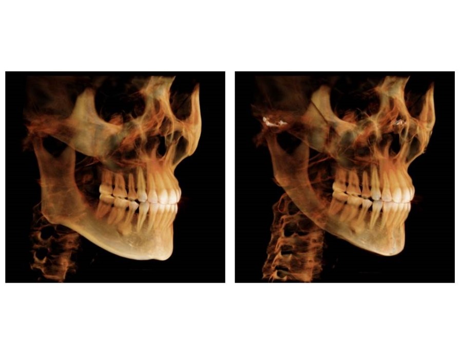 Proper Understanding of Cortical Bone Resection or Cortical Bone Reduction in Square Jaw Surgery image 13
