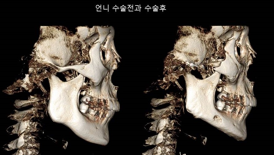 Understanding Square Jaw Surgery - Comparison of Postoperative Results Between Biological Sisters Who Underwent Surgery Using Different Methods image 3