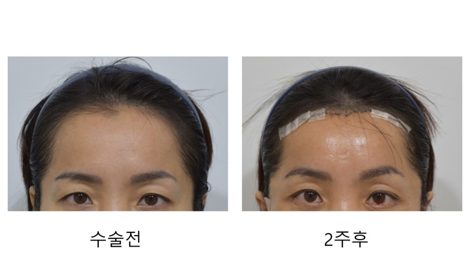 넓은 이마와 처진 눈매 고민 끝! "이마거상, 이마축소, 그리고 바이나리" 관련 이미지 15