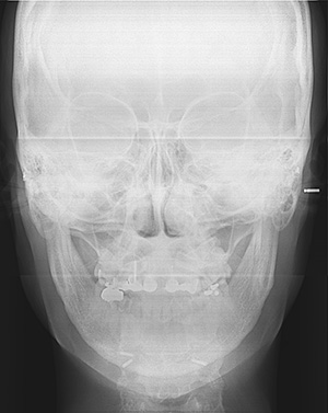 V-Line Square Jaw Revision Surgery image 2