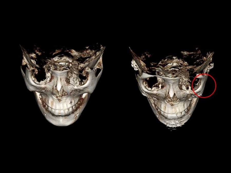 Zygoma Reduction Surgery Through Complete Osteotomy of the Body and Arch image 26