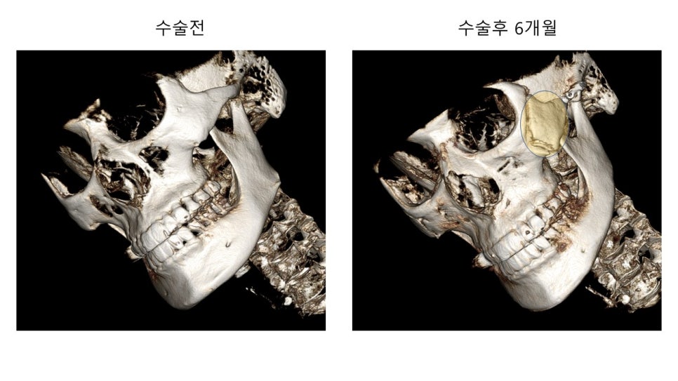 안면윤곽 수술전과 후의 증례 고찰 관련 이미지 12